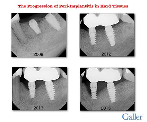 Treatment Of Peri Implantitis With Gum Grafting By Galler