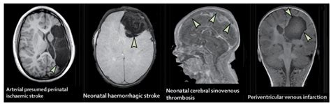 Perinatal Stroke Paediatricfoam