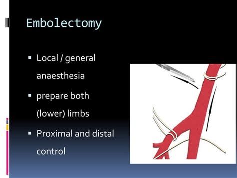 Thrombo embolectomy | PPT