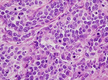 High Grade Urothelial Carcinoma Of The Renal Pelvis Clinicopathologic