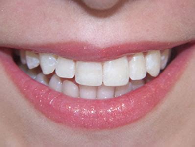 Denti Rovinati E Abrasi Interventi Con Faccette Additionals E