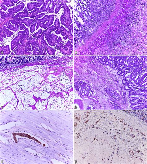 Epithelial Gastrointestinal Neoplasms A Papillary Adenocarcinoma