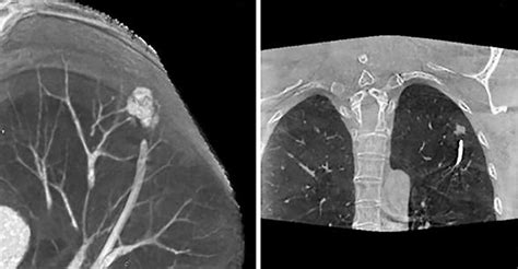 Advancements In Localization Of Peripheral Pulmonary Nodules For Diagnosis And Treatment For