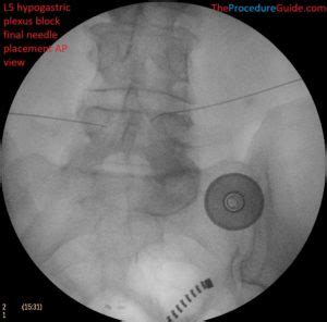 Hypogastric Plexus Block - Technique and Overview - The Procedure Guide