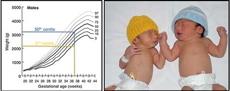 Intrauterine Growth Restriction Causes Symptoms Diagnosis Treatment