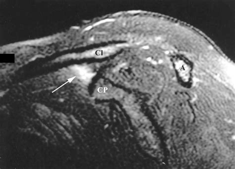 Mr Imaging Appearance And Classification Of Acromioclavicular Joint