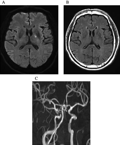 MRI findings. Asymptomatic acute ischemic stroke has slightly increased ...