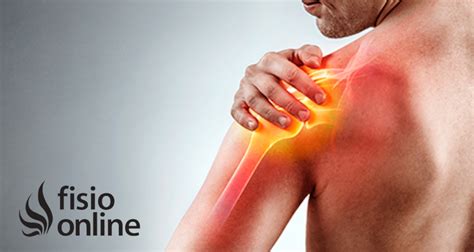 Estrategias Fiit En La Recuperación De Tendinitis Del Hombro Fisioonline