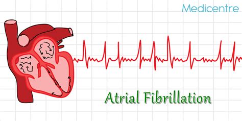 Atrial Fibrillation Causes Symptoms And Treatments