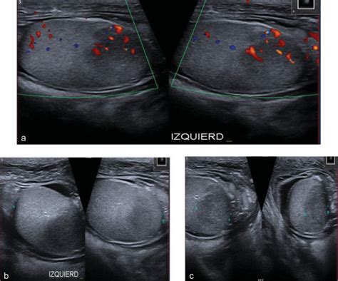 A C Ecograf A Doppler Testicular Test Culo Izquierdo Con Dos