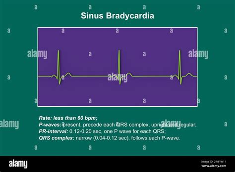 Sinus Bradycardia Heartbeat Rhythm Illustration Stock Photo Alamy