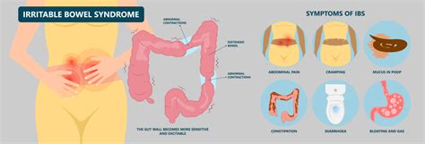 Irritable Bowel Syndrome Ibs In Singapore Dr Benjamin Yip