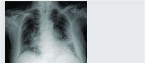 Pneumonia Chest X Ray Diagnosis