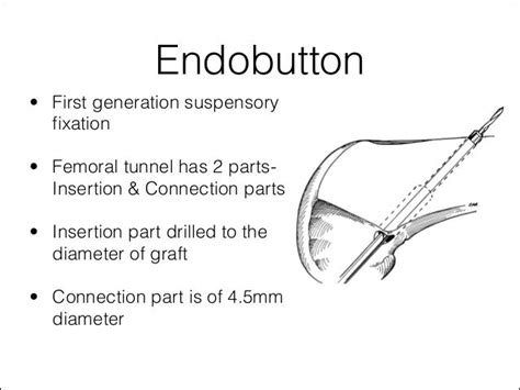 Acl graft fixation options