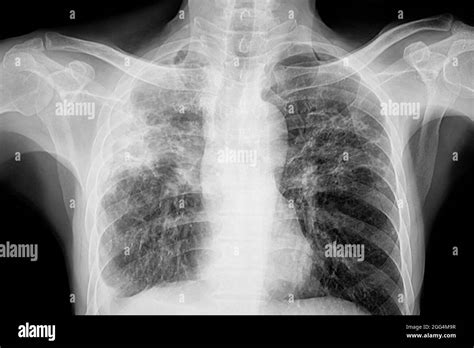 La Radiografía De Tórax Del Paciente Con Tuberculosis Pulmonar Que