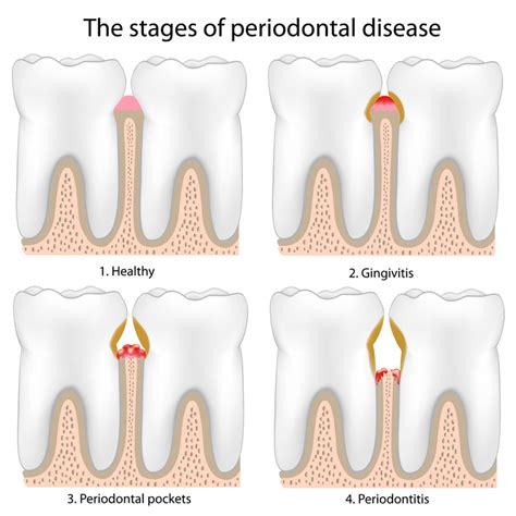 Periodontal Disease Stages Los Angeles Gum Disease Treatment