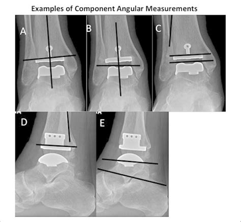 Representative Postoperative Weightbearing Radiographs Are Shown