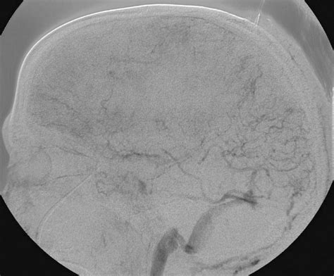 Intracranial Dural Sinus Thrombosis Novel Use Of A Mechanical