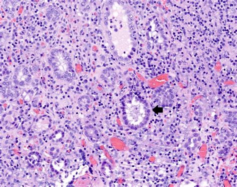 Pathology Outlines Nephrogenic Metaplasia