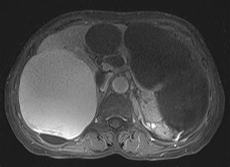 Preoperative T Weighted Magnetic Resonance Imaging Showing Different