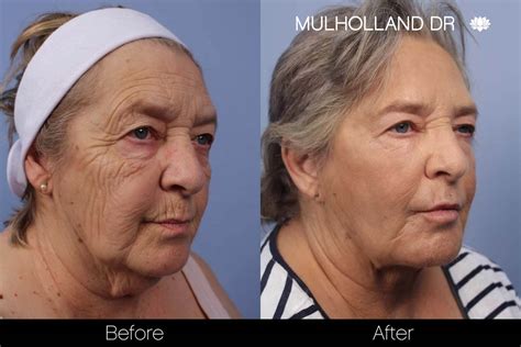 Cheek Lift Surgery Mid Facelift Toronto Plastic Surgeons