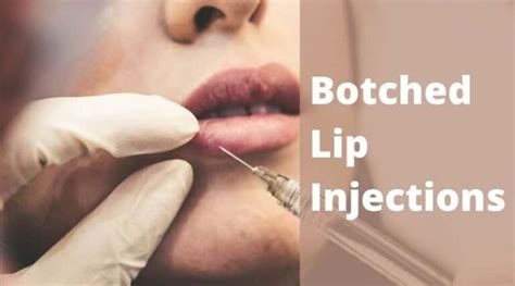 ️What are Botched Lip Injections? | HealthtoStyle