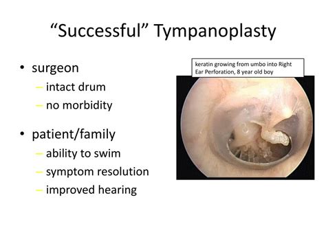 Types Of Tympanoplasty