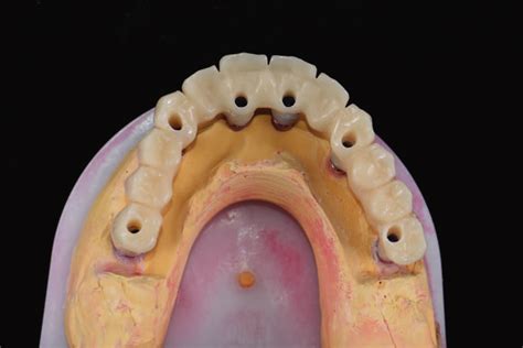 Temporary restoration. Occlusal view extraorally. | Download Scientific ...