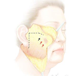 Pdf Consideration Of Facelift Methods And Facial Retaining Ligaments