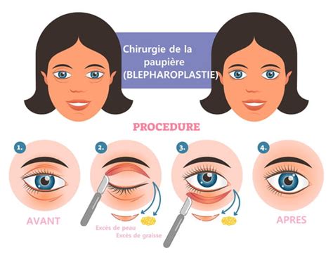 Blépharoplastie paupières technique prix prise en charge