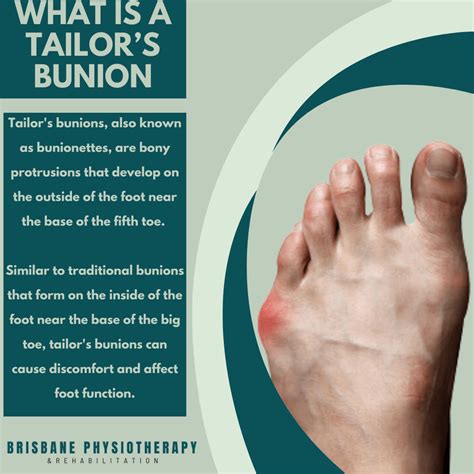 bunion symptoms