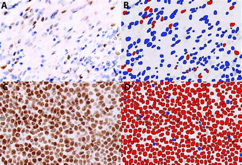 Digital Quantificantion Of C MYC Immunohistochemical Stain Using