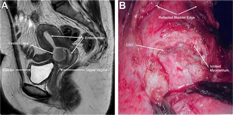 Identification And Excision Of A Fistulous Cesarean Scar Defect Journal Of Obstetrics And