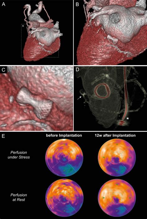 Coronary Computed Tomography Angiography Derived 3d Reconstruction Of