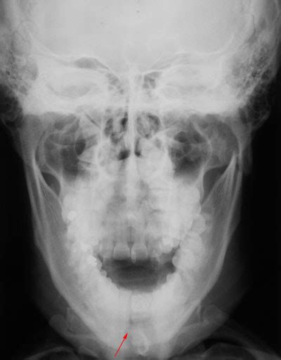 Caso 218 FRACTURA MANDIBULAR CDI