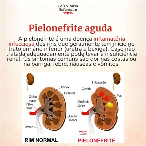Pielonefrite Mata Em Quanto Tempo - 🔬 Entendendo a Pielonefrite: O que você precisa saber 🩺 | Laís Vitória ...