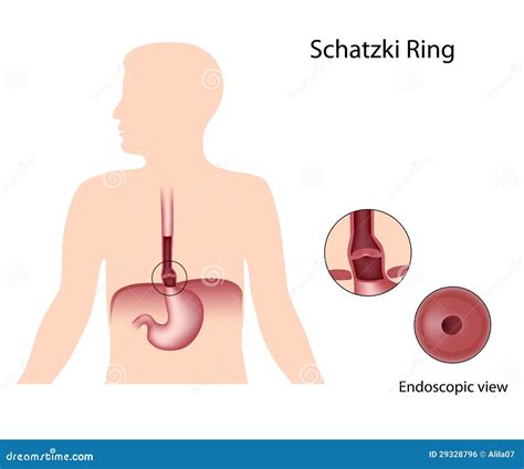 Schatzki ring stock vector. Illustration of dysphagia - 29328796