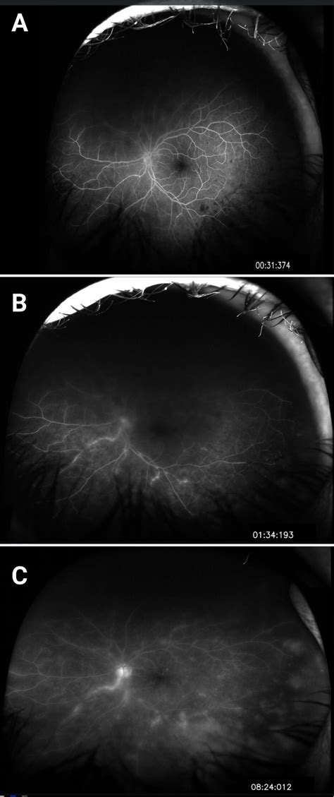 Eyerounds Org Bilateral Acute Retinal Necrosis