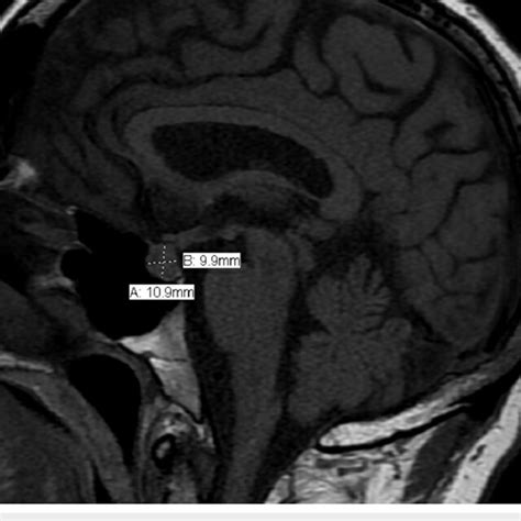 Mri Brain Showing Pituitary Gland Enlargement In Sagittal Section Mri