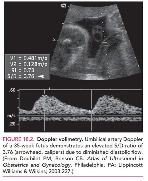 Intrauterine Growth Restriction Diagnosis