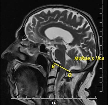 Basilar Invagination Radiology Case Radiopaedia Org