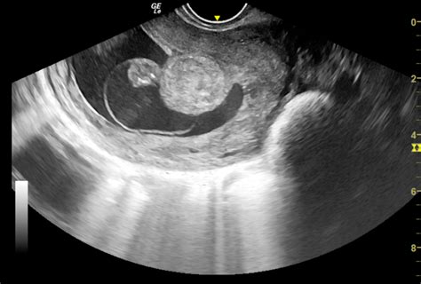 Transvaginal Sonographic Diagnosis Of An Endometrial Polyp Causing