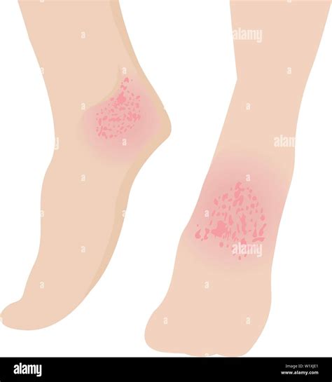 Eczema Affected A Foot Dermatology Skin Disease Concept Vector