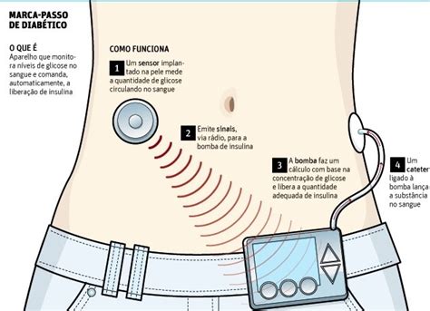 Uso da bomba de insulina desde o diagnóstico pode beneficiar diabéticos