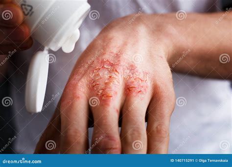 Eczema on the Hands. the Man Applying the Ointment , Creams in the ...