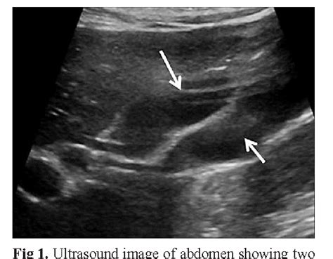 Pdf Imaging Findings Of Gallbladder Duplication Due To Two Cases