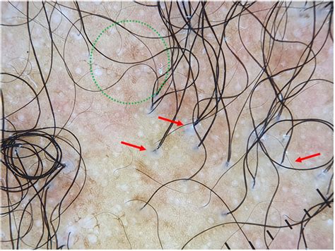 The Dermatoscope In The Hair Clinic Trichoscopy Of Scarring And Nonscarring Alopecia Journal