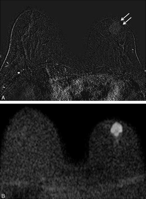 Invasive Ductal Carcinoma Of The Left Breast In A 55 Y Old Woman A