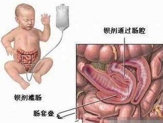 寶寶腸套疊四大症狀抓住救命的黃金12小時 每日頭條