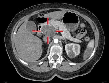 Pancreatic cancer - Wikipedia